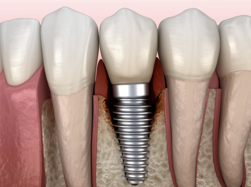 南方医院种植牙贵不贵?最新价格+真实案例,一文算清性价比