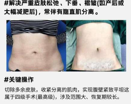 成都华西可以抽脂吗?技术好吗?全新价目表公布!